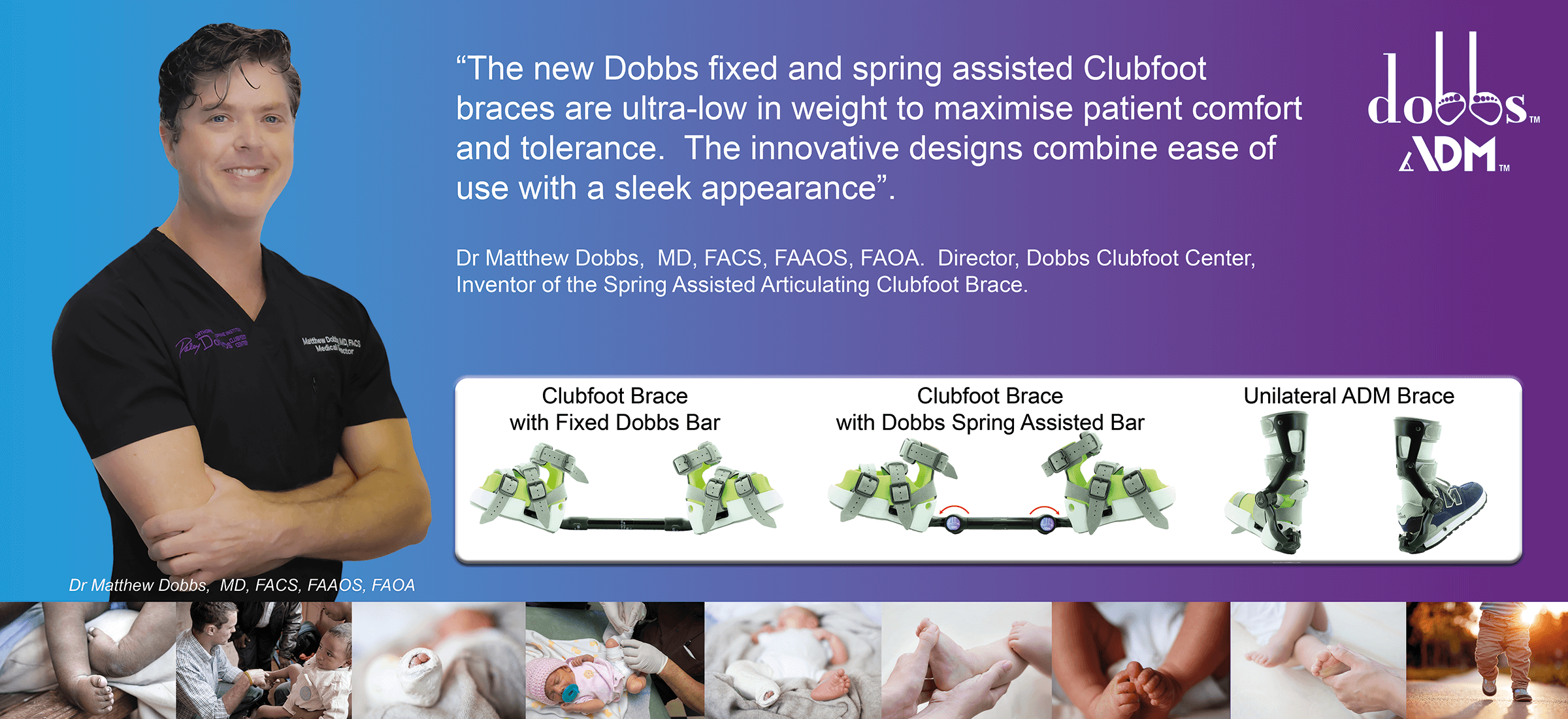The new Dobbs fixed and spring assisted Clubfoot braces are ultra-low in weight to maximise patient comfort and tolerance